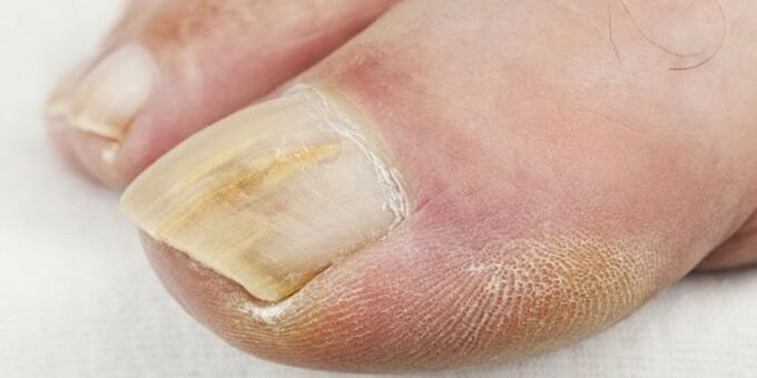 síntomas de hongos en las uñas de los pies