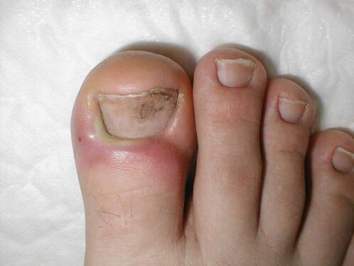 gotas para el tratamiento de hongos en las uñas de los pies