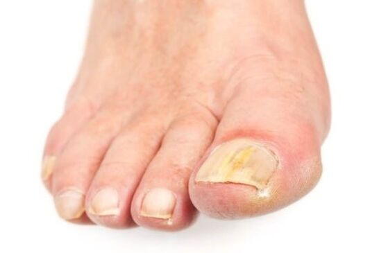 sintomas de hongos en los pies
