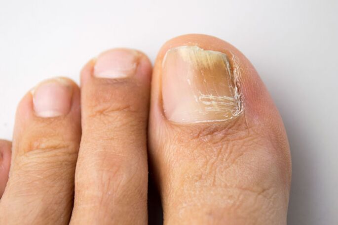 hongos en el dedo gordo del pie