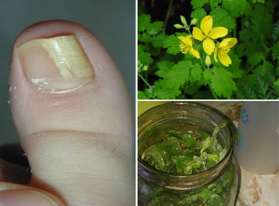 celidonia para el tratamiento de hongos en las uñas de los pies