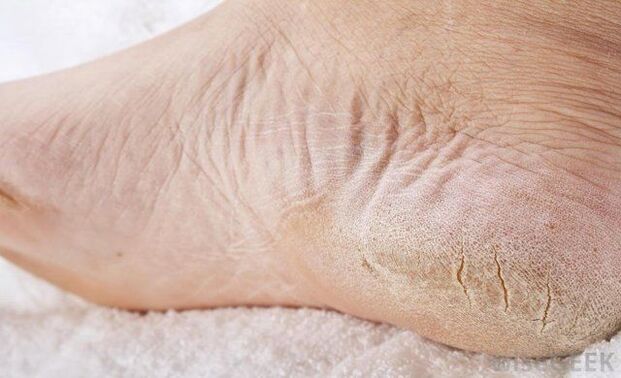Los pies secos son un signo de hongos. 