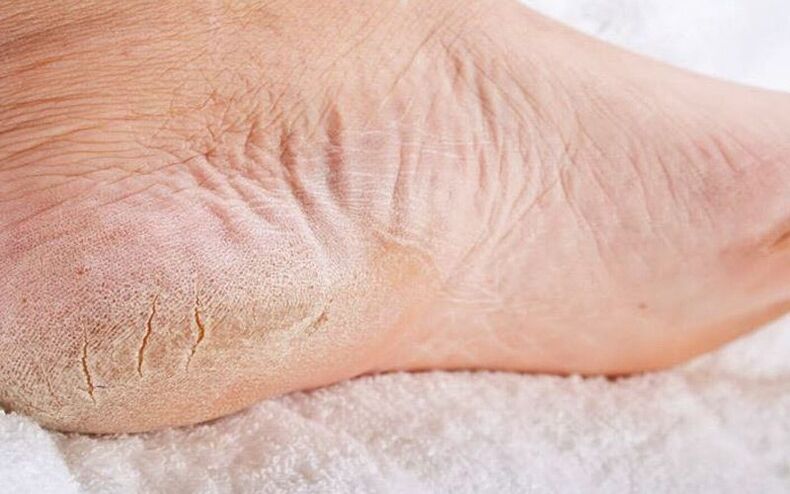 síntomas de hongos en los pies