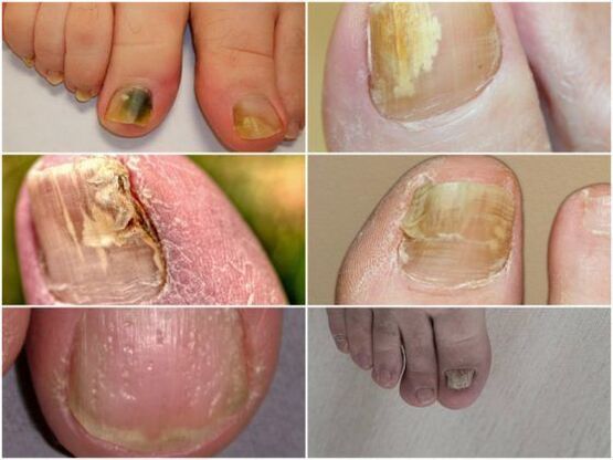 síntomas de infección por hongos en las uñas