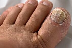 Foto de hongos de uñas