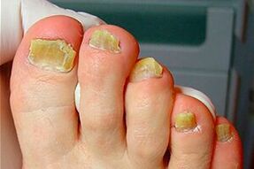 Hongo de uñas