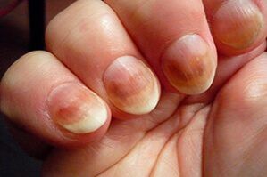 hongo de uñas