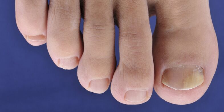 Síntomas de la micosis de la piel y placas de uñas