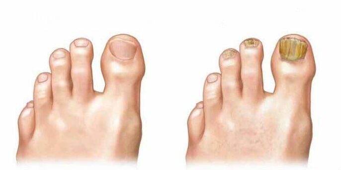 ¿Cómo se ve el hongo en las uñas