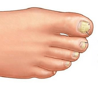 Onicomicosis