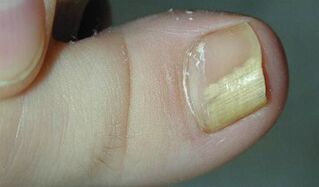 Signos y síntomas del hongo de las uñas