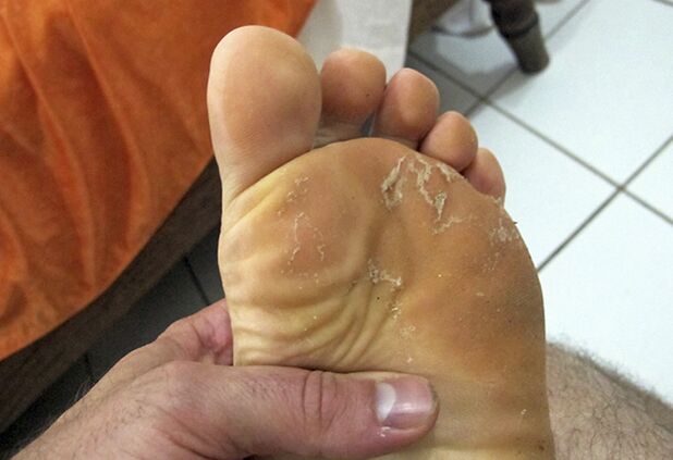 hongo en la piel de las piernas