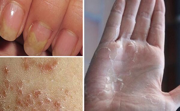 ¿Puede la micosis cambiar a otras partes del cuerpo