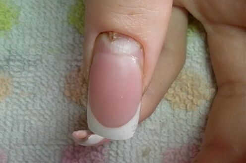 síntomas de hongos en las uñas