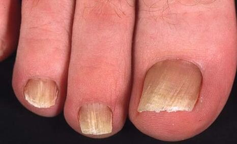 tipo de hongo en las uñas de los pies
