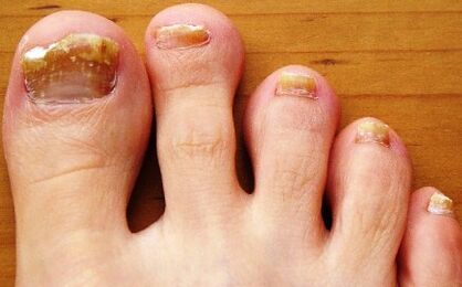 uñas de los pies afectadas por hongos