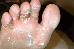 hongos en dedos y pies