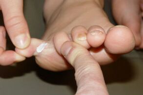 hongos en los dedos de los pies