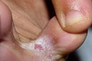 síntomas de hongos entre los dedos de los pies