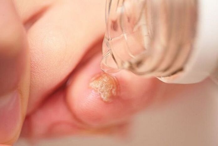 tratamiento de hongos en las uñas de los pies con vinagre
