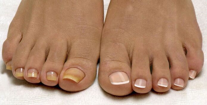 uñas de los pies y uñas sanas afectadas por hongos
