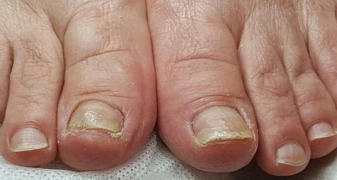 daño en las uñas con hongos en los pies