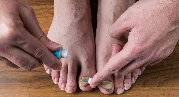 tratamiento de hongos en las uñas de los pies
