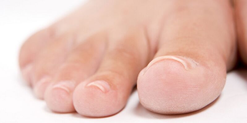la etapa inicial de hongos en las uñas de los pies