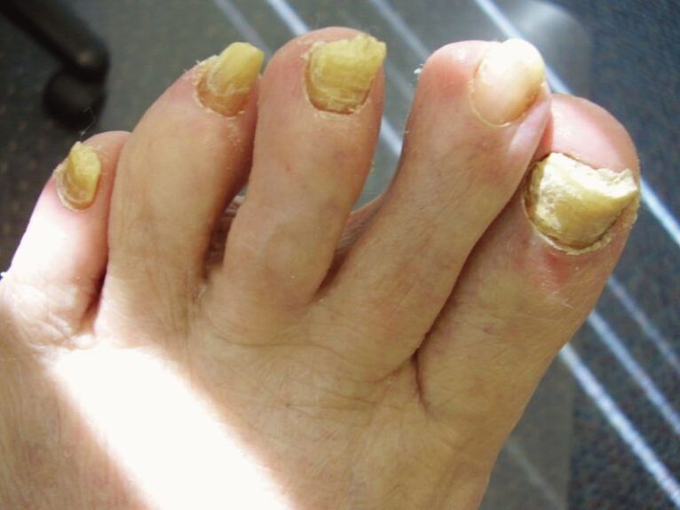 hongos en las uñas de los pies descuidados