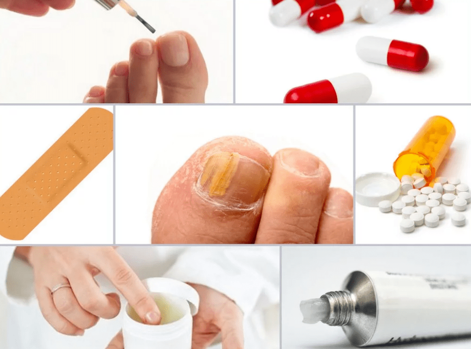 medicamentos sistémicos para hongos en las uñas de los pies