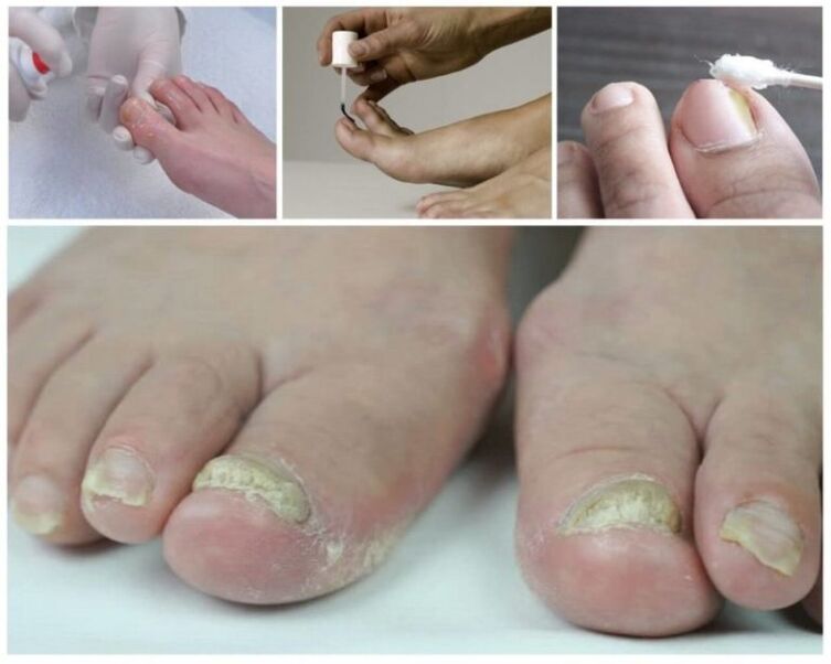 remedios para hongos en las uñas de los pies