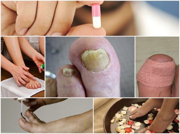 tipos de remedios para los hongos en las uñas de los pies