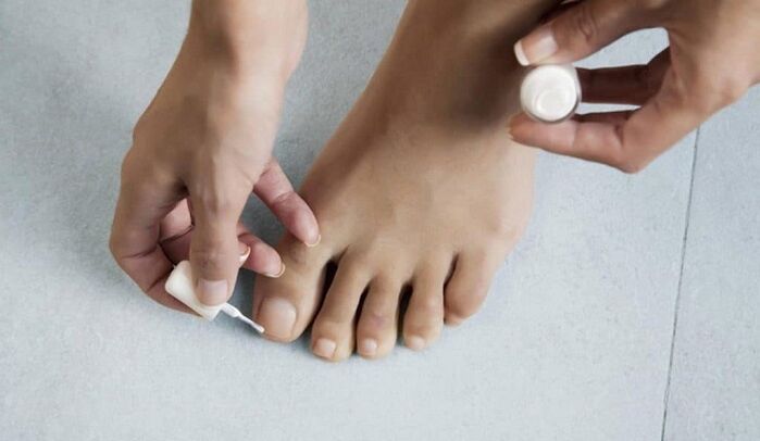 tratamiento de hongos en el dedo gordo del pie con barniz