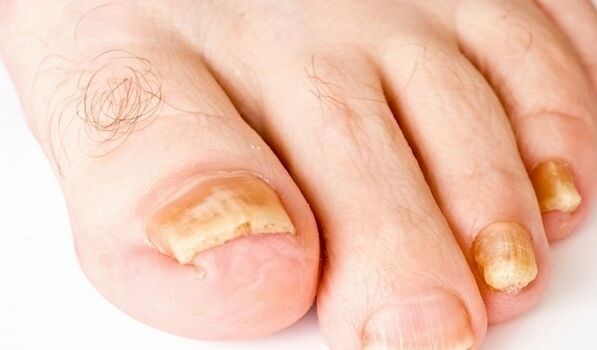 foto de síntomas de hongos en las uñas de los pies