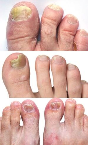 foto de hongos en las uñas de los pies