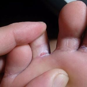 grieta entre los dedos de los pies síntomas de hongos